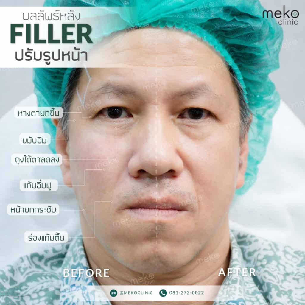 ฟิลเลอร์-เมโกะ-คลินิก-คุณอ๋อง