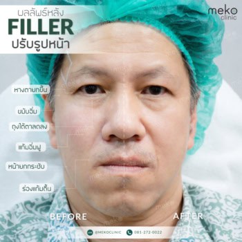 ฟิลเลอร์-เมโกะ-คลินิก-คุณอ๋อง