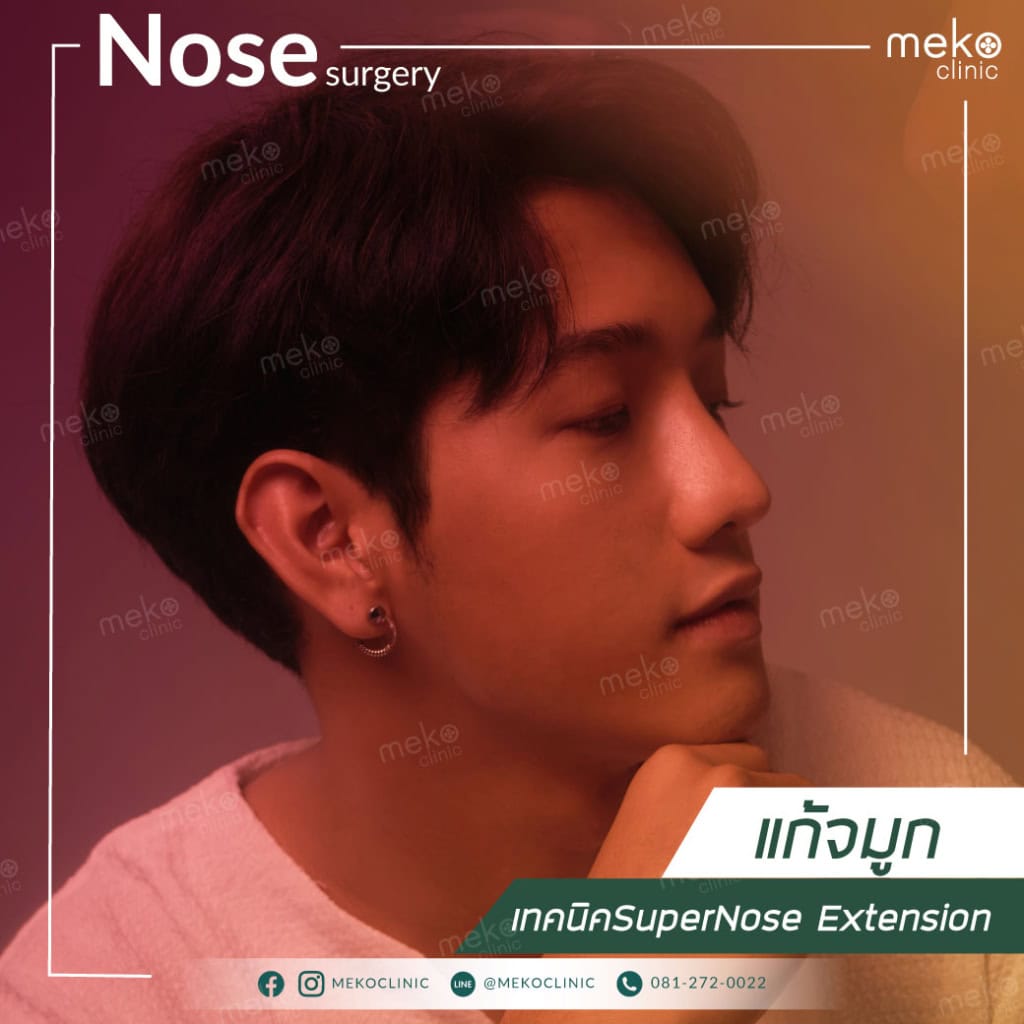 แก้จมูก สายเกา หน้าละมุนด้วยเทคนิคSuperNose Extension