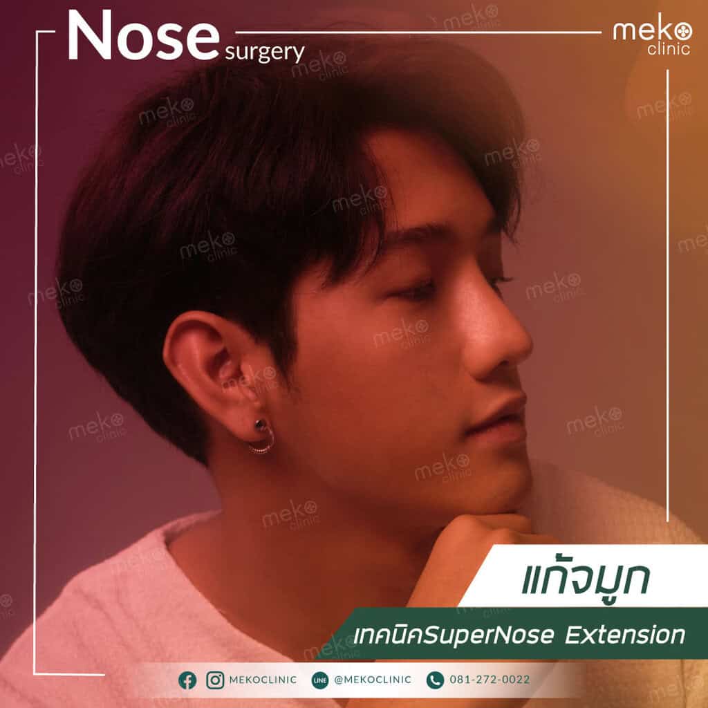 แก้จมูก สายเกา หน้าละมุนด้วยเทคนิคSuperNose Extension
