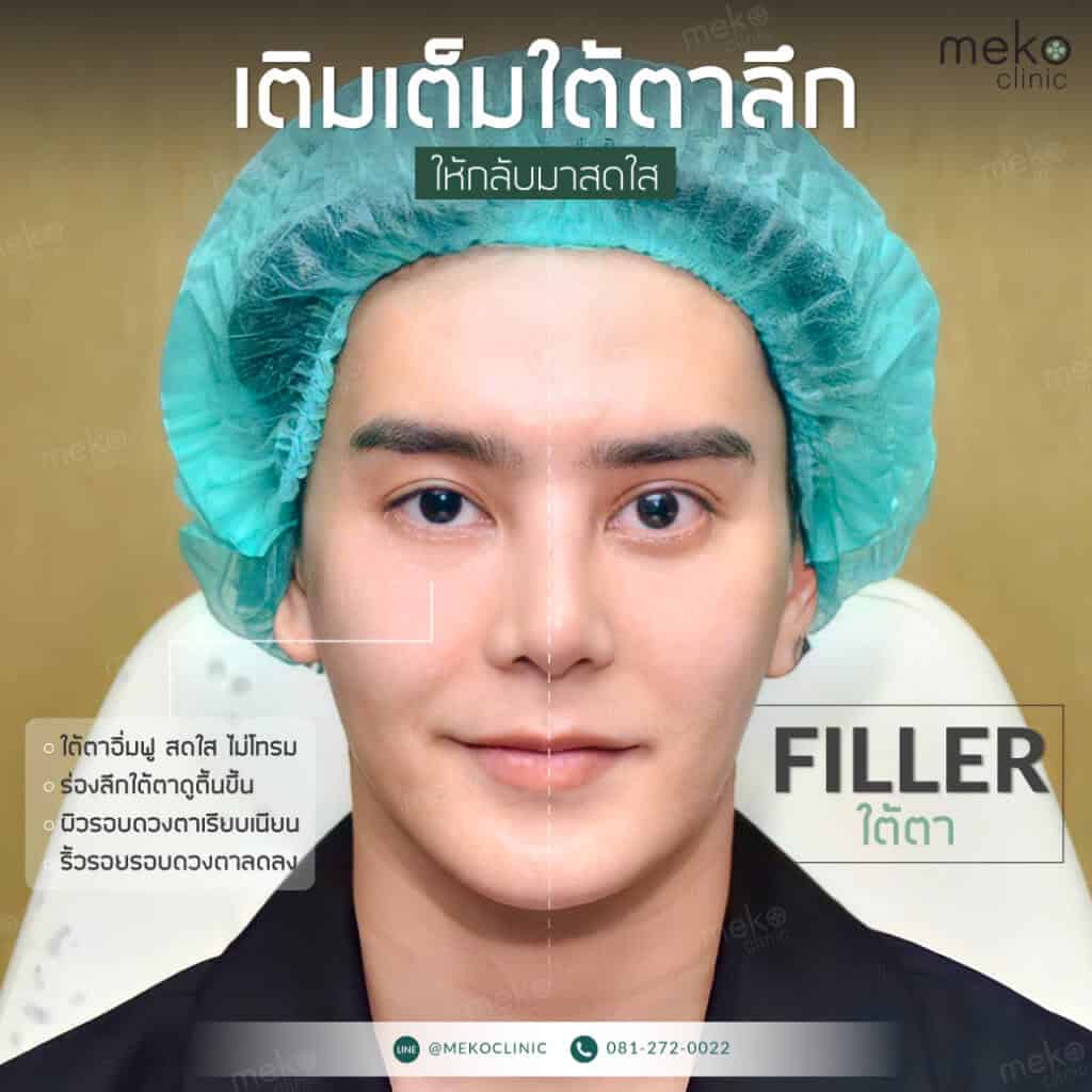 Filler หมอทินน์ เมโกะ คลินิก คุณอาร์ม
