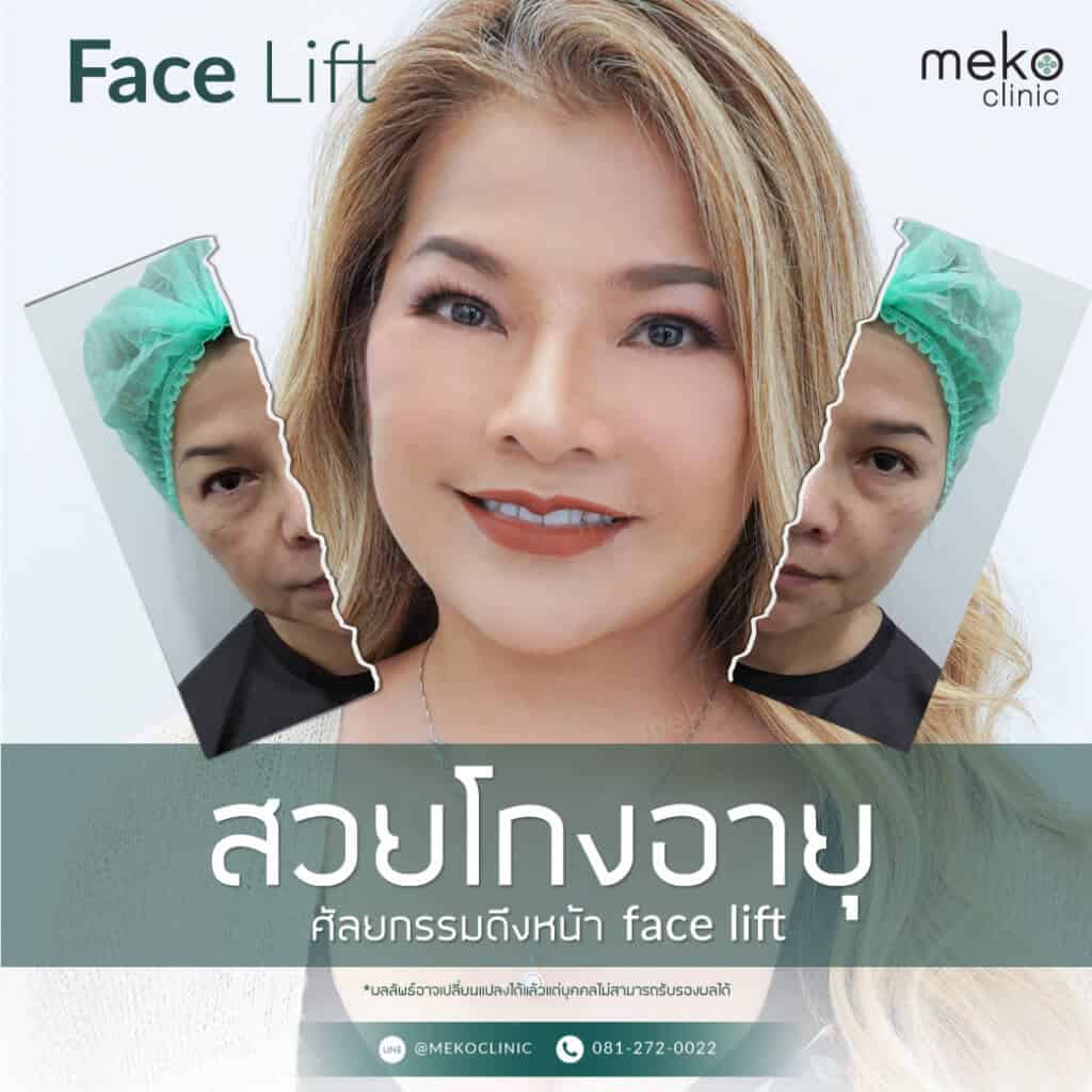 สวยโกงอายุ ศัลยกรรมดึงหน้า Facelift โดยแพทย์ยศ [คุณหยก]