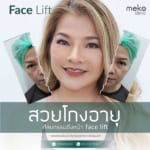 สวยโกงอายุ ศัลยกรรมดึงหน้า Facelift โดยแพทย์ยศ [คุณหยก]