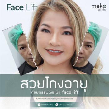 สวยโกงอายุ ศัลยกรรมดึงหน้า Facelift โดยแพทย์ยศ [คุณหยก]