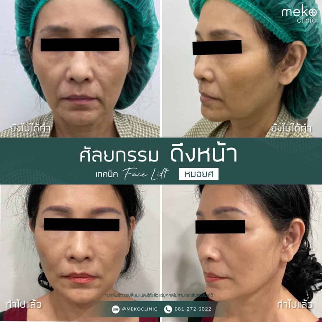 ดึงหน้าย้อนวัย โดยแพทย์ยศ [คุณจี]