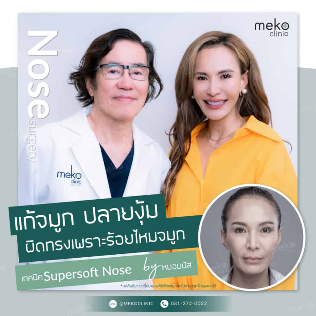 รีวิวเสริมจมูกเทคนิค super soft nose แก้จมูก ปลายงุ้ม ผิดทรง