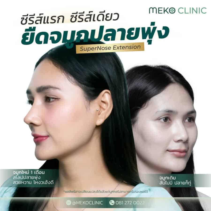 banner-เสริมจมูก-ซีรีส์แรก-1040x1040-01