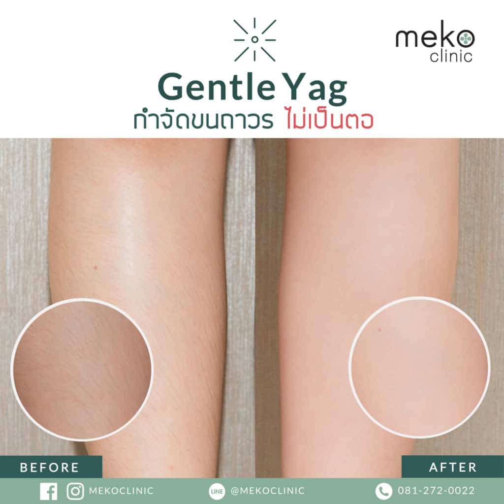 meko clinic gentle yag
