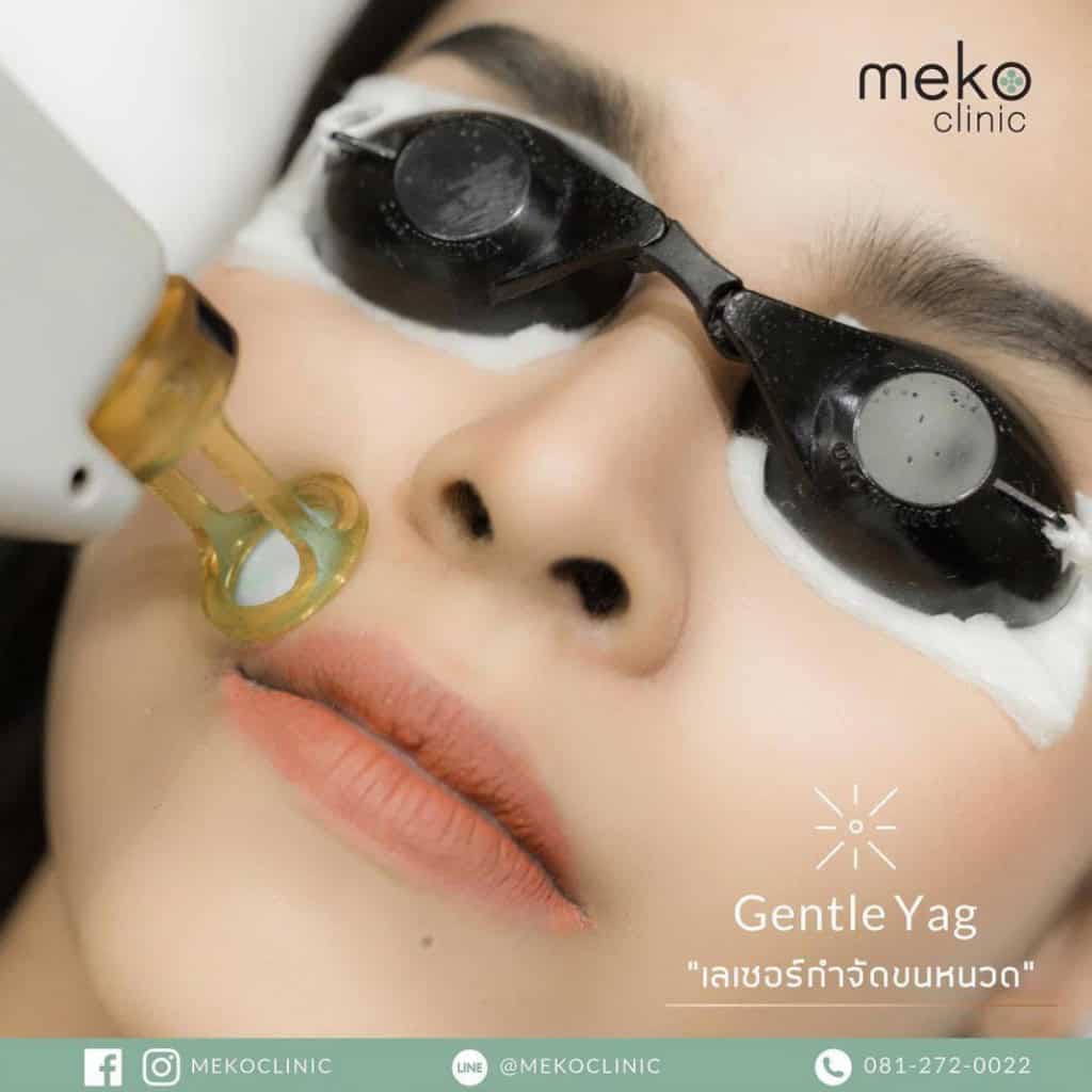 meko clinic gentle yag