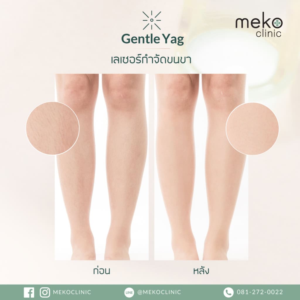 meko clinic gentle yag