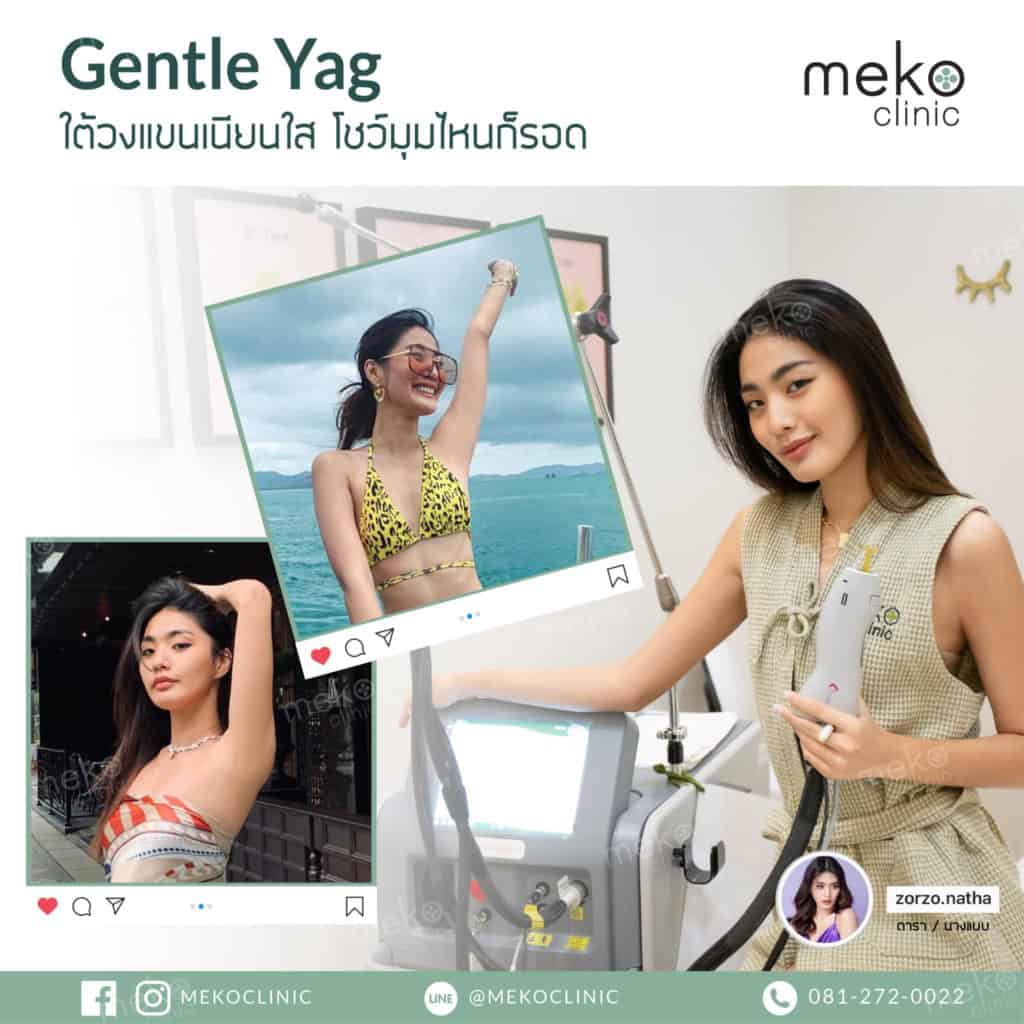 meko clinic gentle yag
