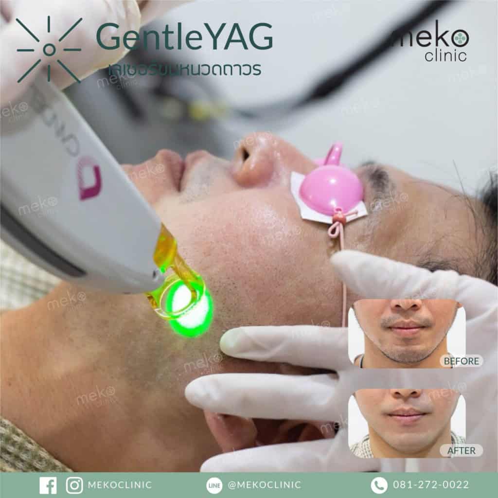 meko clinic gentle yag กำจัดขน