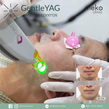 meko clinic gentle yag กำจัดขน