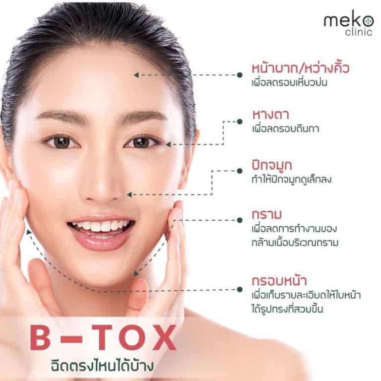 ฉีด(B-tox) มีกี่แบบ กี่วันเห็นผล เลือกยี่ห้อไหนดี เตรียมตัวก่อน – หลังฉีด