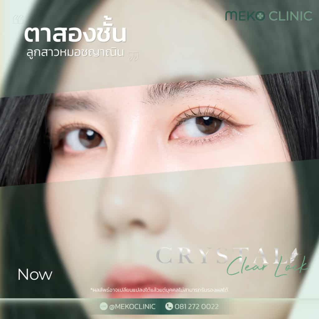 วิธีการทำศัลยกรรมตาสองชั้น และการเตรียมความพร้อมก่อนเข้ารับการผ่าตัด