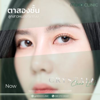 วิธีการทำศัลยกรรมตาสองชั้น และการเตรียมความพร้อมก่อนเข้ารับการผ่าตัด