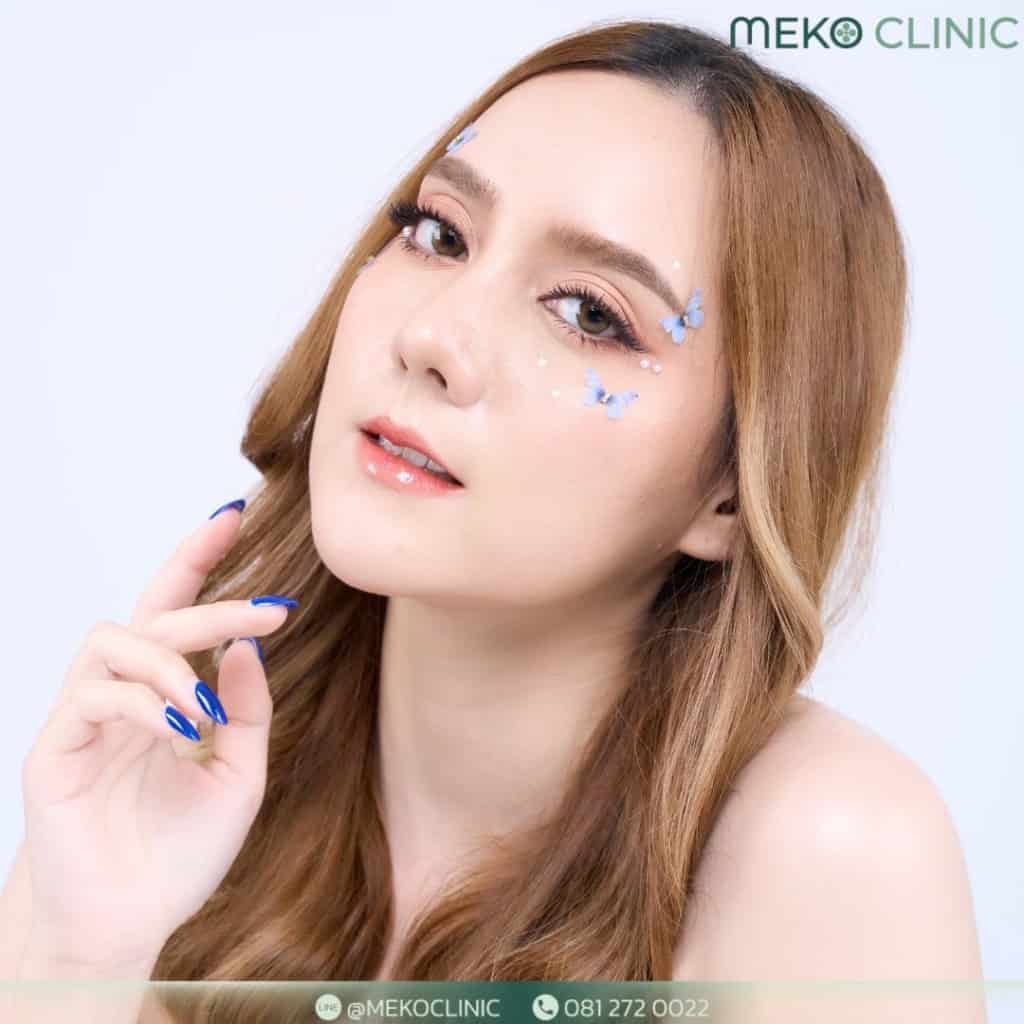 คุณเจนนี่ อัปเดตหลังเสริมจมูกแบบ Open