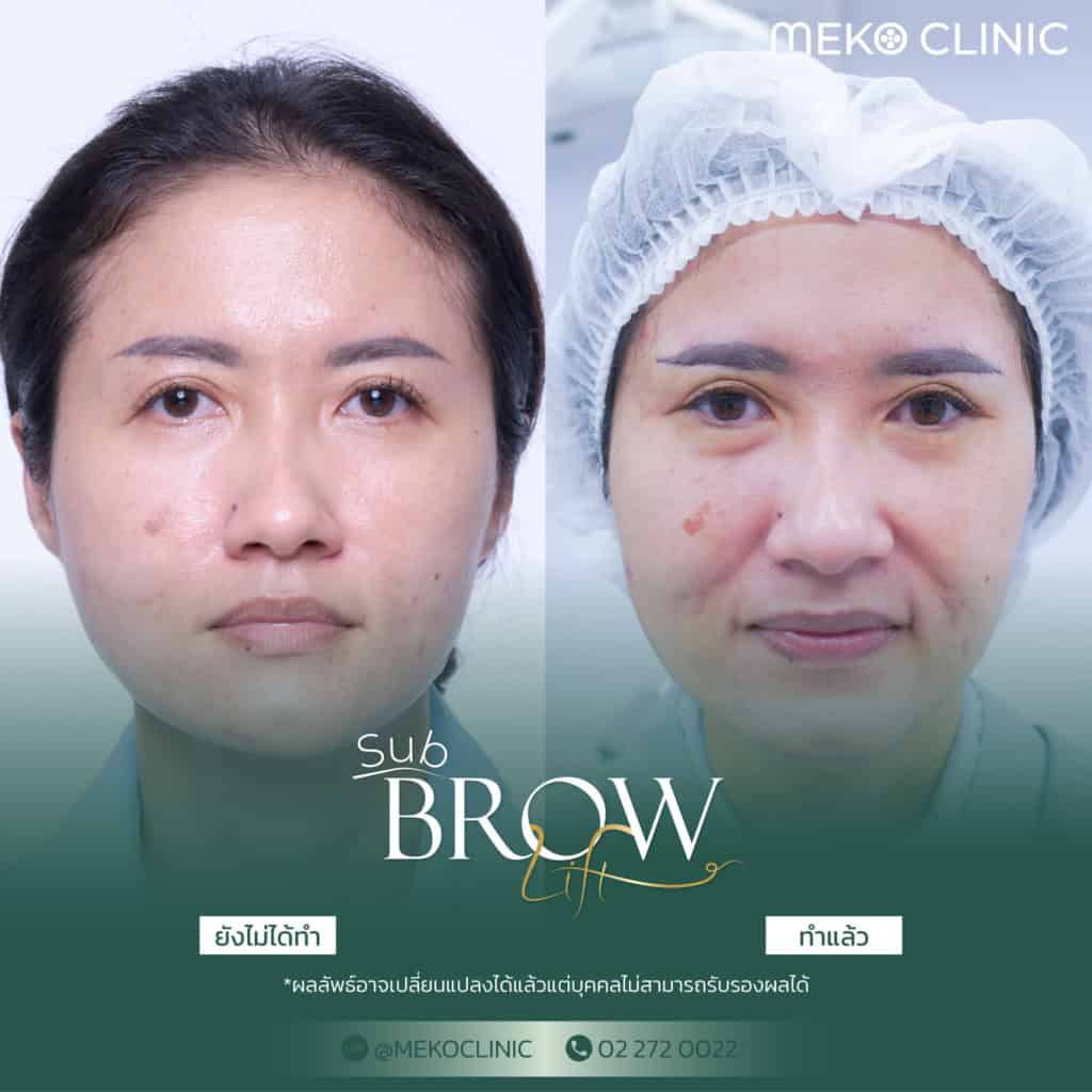 Sub brow lift เทคนิคสุดพิเศษของเมโกะคลินิก โดยศัลยแพทย์ตกแต่ง