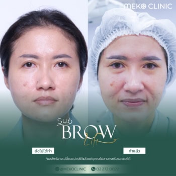 Sub brow lift เทคนิคสุดพิเศษของเมโกะคลินิก โดยศัลยแพทย์ตกแต่ง