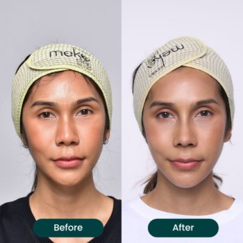 รีวิืวเสริมจมูก เทคนิคopen ปรับใบหน้าดุ ให้หวานละมุน ครบ3เดือน(คุณจีจี้)