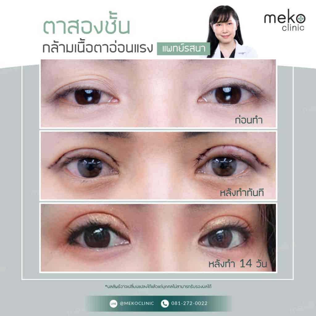 แก้ไขกล้ามเนื้อตาอ่อนแรง โดยแพทย์รสนา