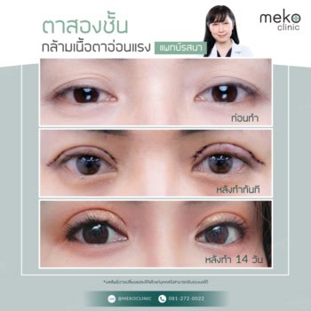 แก้ไขกล้ามเนื้อตาอ่อนแรง โดยแพทย์รสนา