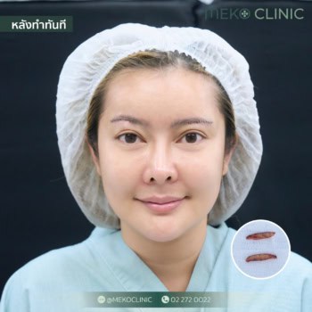 Sub Brow Lift แก้ปัญหาตาตก ไม่ต้องผ่าตัด updateหลังทำ 7 วัน แผลเล็กมาก (คุณเอิร์น เดอะสตาร์ )
