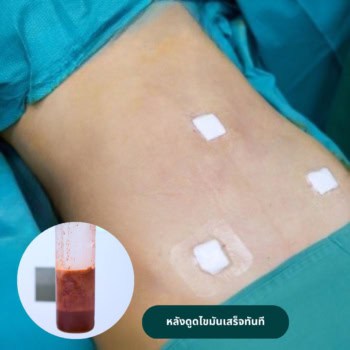 ดูดไขมันหน้าท้องที่เมโกะคลินิก แก้ไขปัญหาไขมันส่วนเกินที่ลดยาก