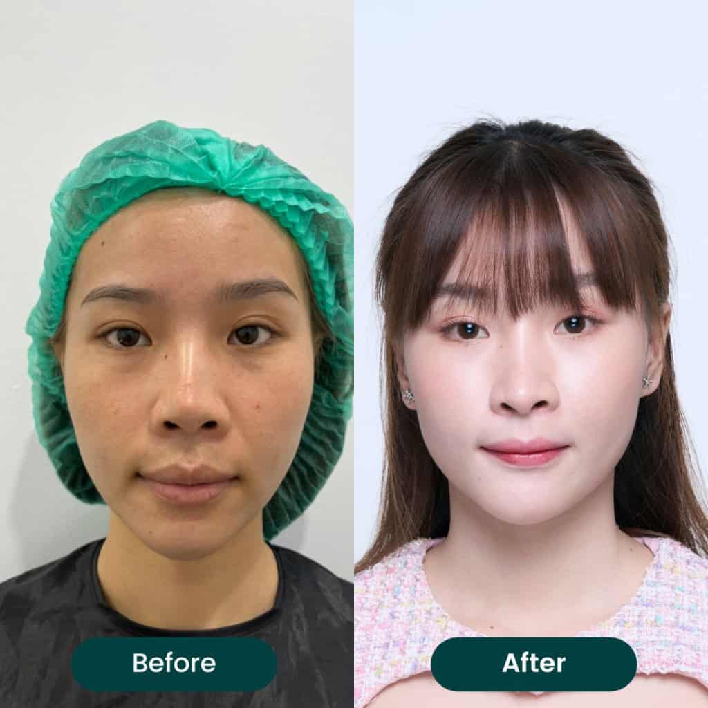 รีวิวแก้จมูกแบบ Open Recon Byหมอวีรกานต์