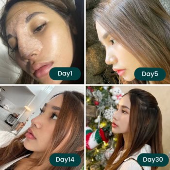 เคสซิลิโคนทะลุปลายจมูก แก้ไขด้วยเทคนิคพิเศษเฉพาะที่เมโกะคลินิก -