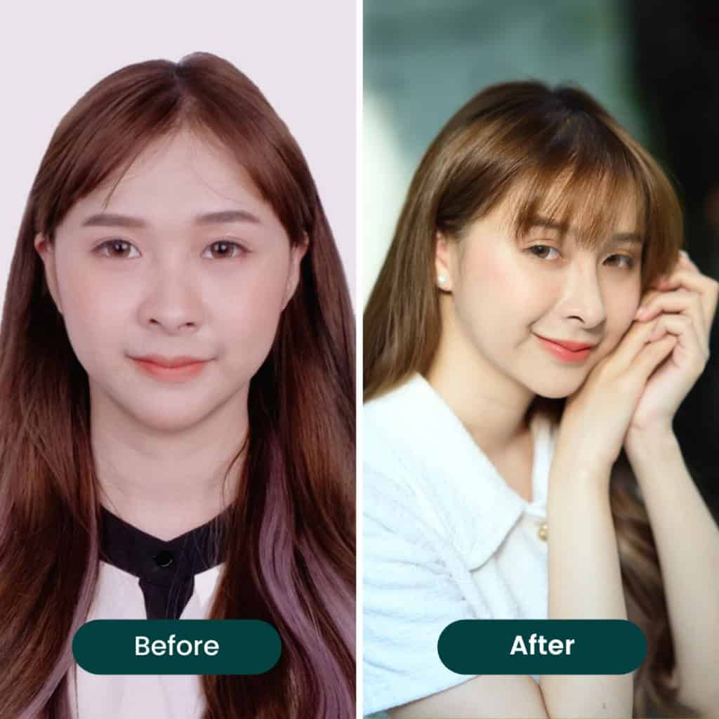 เสริมจมูกด้วยเทคนิค open เคสยาก รูจมูกไม่เท่ากัน จมูกเอียง (คุณป๊อป)