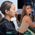 รีวิวเสริมจมูกด้วยเทคนิคพิเศษจากเมโกะคลินิก เปลี่ยนสาวหน้าดุให้หน้าหวานแบบธรรมชาติ ด้วยเทคนิคพิเศษ (คุณญาญ่า)