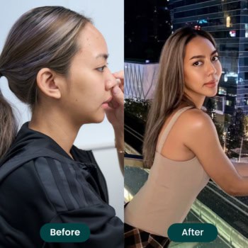 รีวิวเสริมจมูกด้วยเทคนิคพิเศษจากเมโกะคลินิก เปลี่ยนสาวหน้าดุให้หน้าหวานแบบธรรมชาติ ด้วยเทคนิคพิเศษ (คุณญาญ่า)