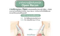 การปรับโครงสร้างจมูกโดยการ open เทคนิต open recon