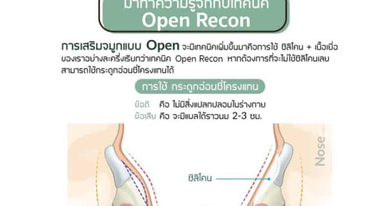 การปรับโครงสร้างจมูกโดยการ open เทคนิต open recon