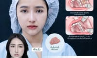 ขั้นตอนการผ่าตัดไขมันกระพุ้งแก้ม (Buccal Fat Pad Removal)