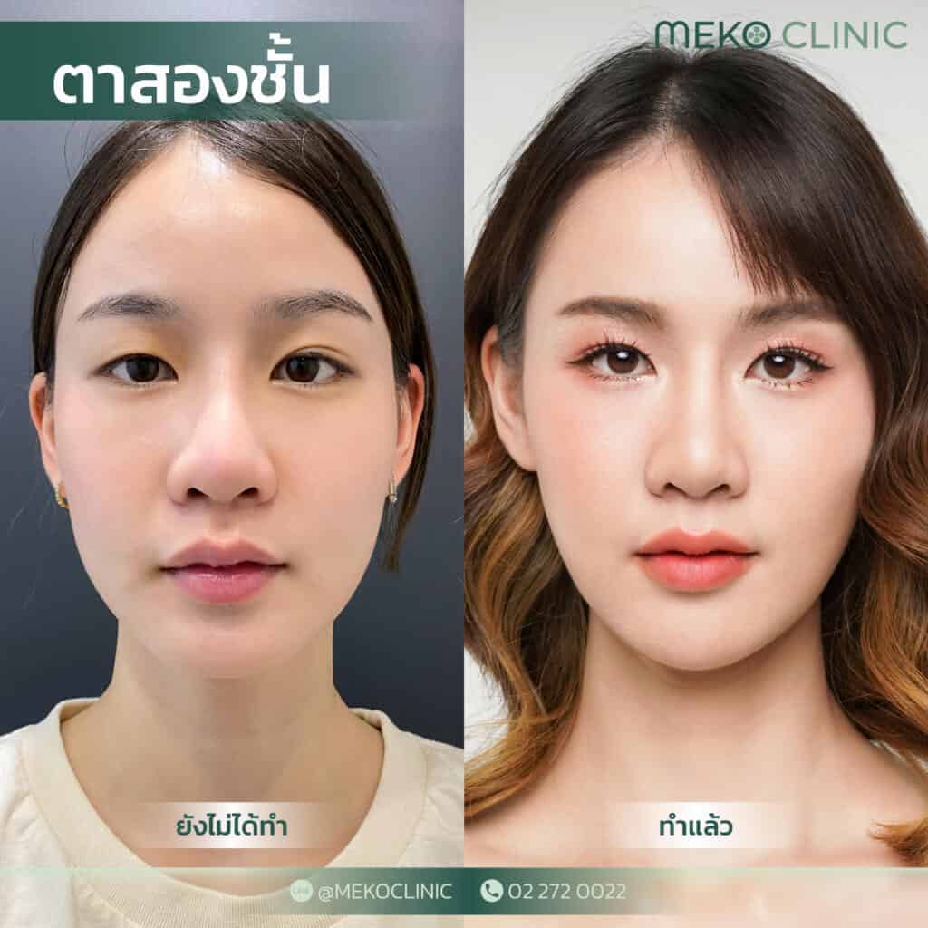 ศัลยกรรมตาสองชั้นแบบธรรมชาติ-แก้ไขชั้นตาไม่เท่ากัน-คุณออมสิน