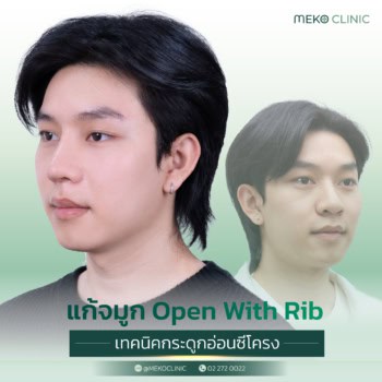 รีวิวน้องต่อ อรรถกร แก้จมูก Open เทคนิคกระดูกอ่อนซี่โครง-
