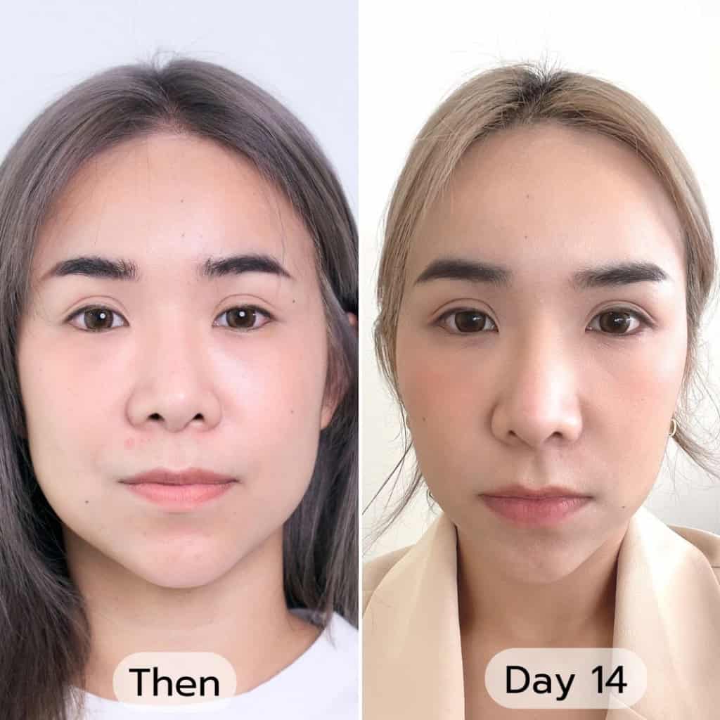 เมื่อเครื่องยกกระชับไม่ตอบโจทย์!! อยากหน้าเรียว สาสมใจ ต้องตัดไขมันแก้ม