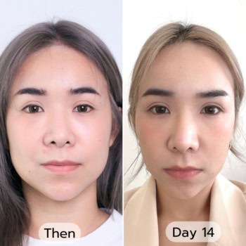 เมื่อเครื่องยกกระชับไม่ตอบโจทย์!! อยากหน้าเรียว สาสมใจ ต้องตัดไขมันแก้ม