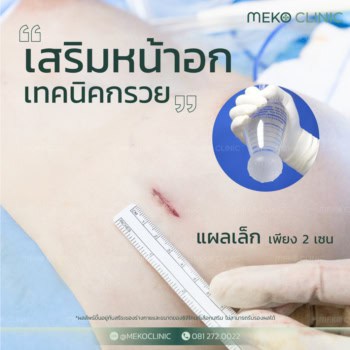 เสริมหน้าอกเทคนิคกรวยด้วยแพทย์ผู้ชำนาญการที่เมโกะคลินิก แผลเล็กเพียง 2 เซนติเมตร