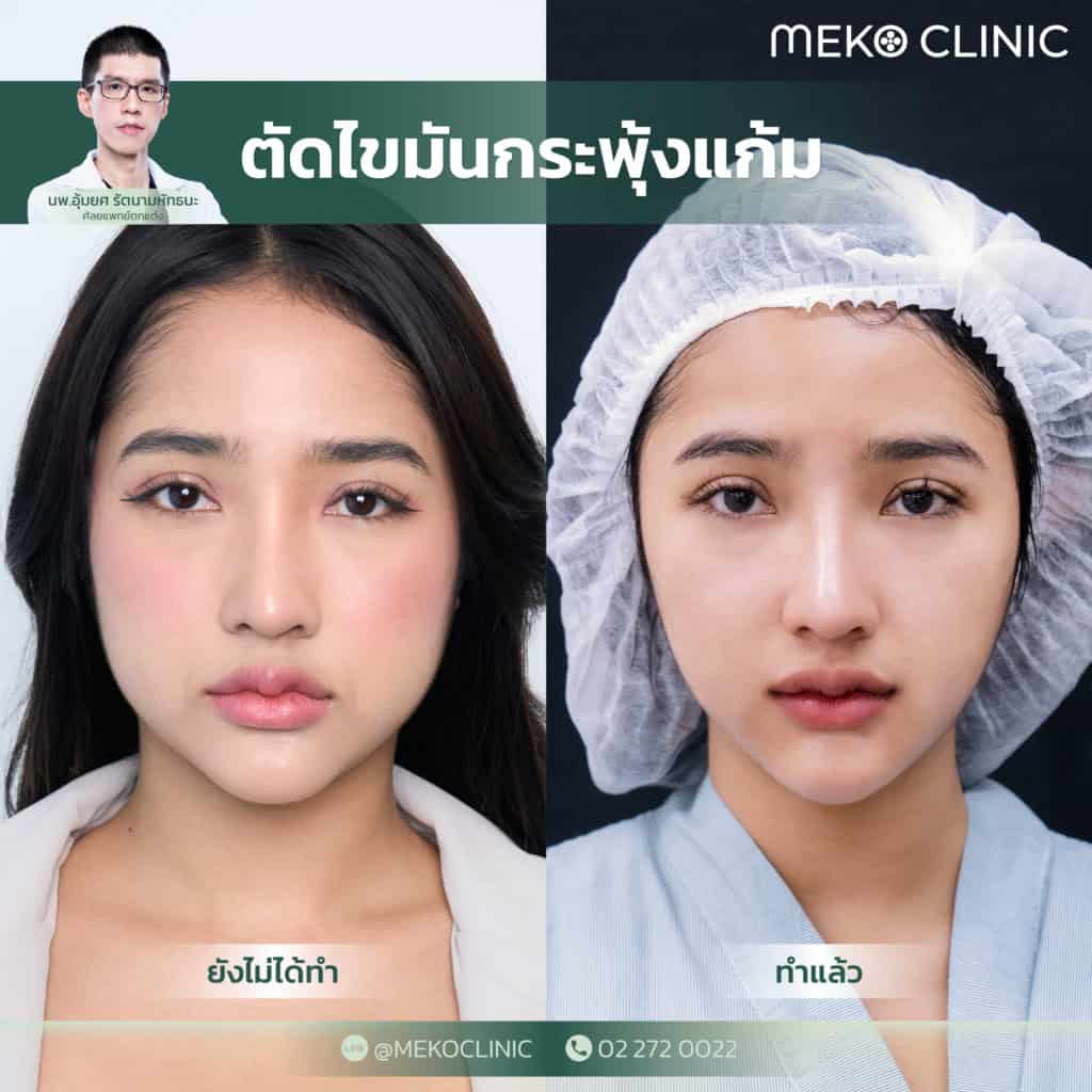 วิธีลดแก้มที่ไวที่สุด รีวิวตัดไขมันแก้ม ฉบับสาวแก้มป่อง (คุณควีน-หมออุ้มยศ)