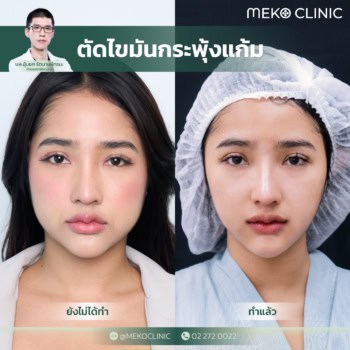 วิธีลดแก้มที่ไวที่สุด รีวิวตัดไขมันแก้ม ฉบับสาวแก้มป่อง (คุณควีน-หมออุ้มยศ)