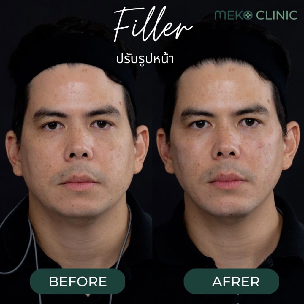 ฟิลเลอร์ปรับรูปหน้า เติมเต็มร่องลึกบนใบหน้าให้กลับมาอ่อนเยาว์ [คุณทิม]