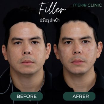 ฟิลเลอร์ปรับรูปหน้า เติมเต็มร่องลึกบนใบหน้าให้กลับมาอ่อนเยาว์ [คุณทิม]