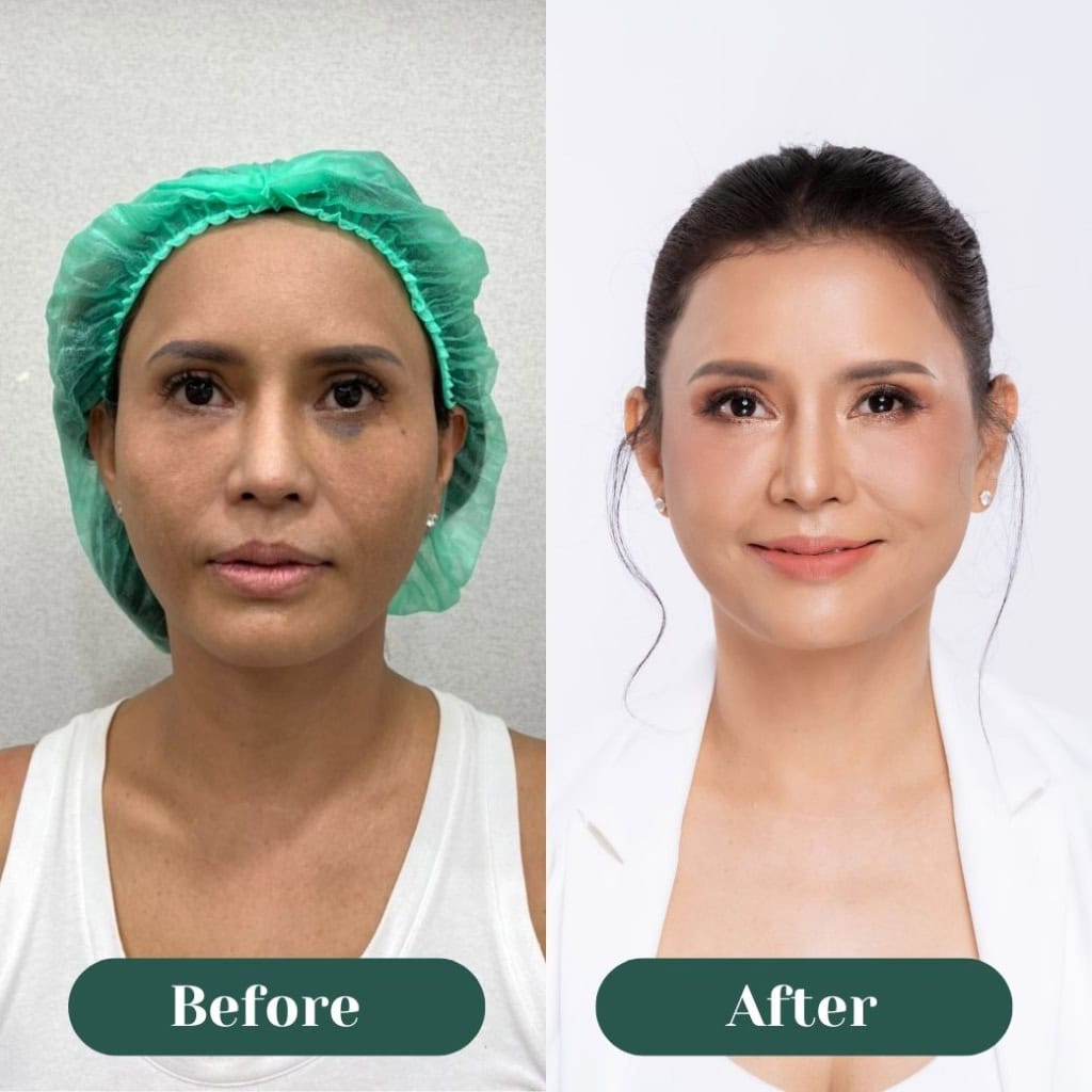 Morpheus8 มิติใหม่แห่งการยกกระชับ ปรับผิวให้เรียบเนียน โดยไม่ต้องผ่าตัด (พี่แดง)