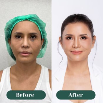 Morpheus8 มิติใหม่แห่งการยกกระชับ ปรับผิวให้เรียบเนียน โดยไม่ต้องผ่าตัด (พี่แดง)