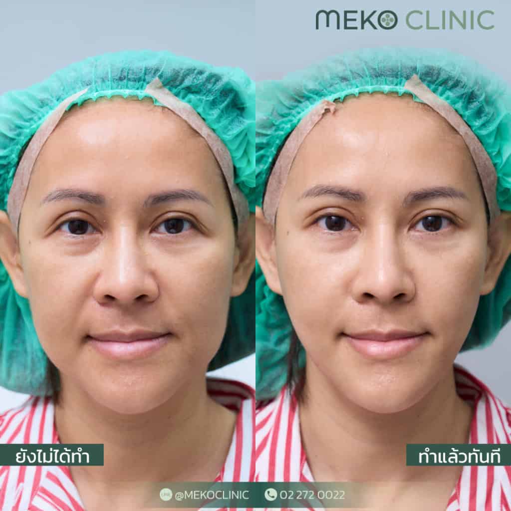 รีวิวร้อยไหมยกกระชับด้วย ไหมอิตาลี แก้ปัญหาความหย่อยคล้อยของใบหน้า (คุณหลิน)