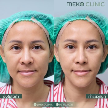 รีวิวร้อยไหมยกกระชับด้วย ไหมอิตาลี แก้ปัญหาความหย่อยคล้อยของใบหน้า (คุณหลิน)