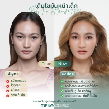 เติมไขมันหน้าเด็กช่วยอะไรบ้าง